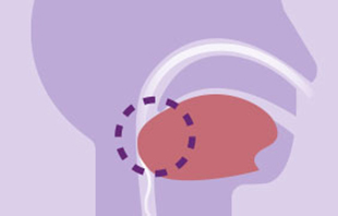 &iquest;Qu&eacute; es la apnea obstructiva del sue&ntilde;o?