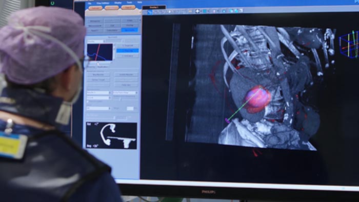 Biopsia y ablación de tumores