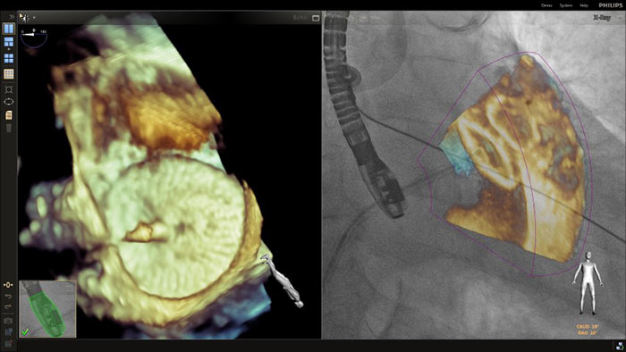 Superposici&oacute;n de zoom 3D en un procedimiento de cierre de LAA